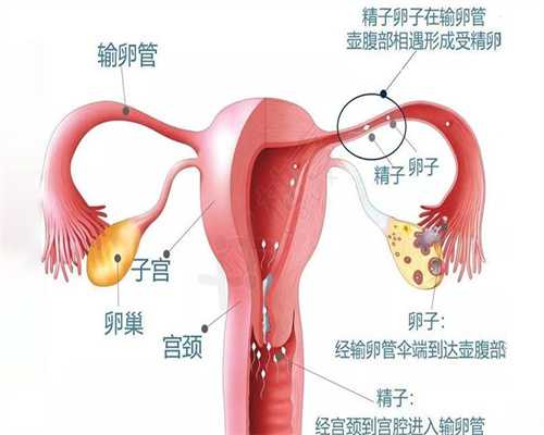 输卵管阻塞－如何自然怀孕及治疗方法