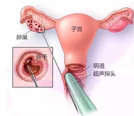 湛江潍坊捐卵群~卵巢恶性肿瘤3种病因，卵巢肿瘤早期有哪些症状？