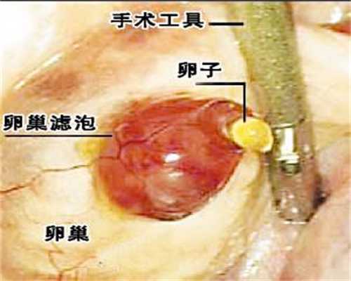 义乌捐卵女孩~广州供卵试管试管婴儿总费用划分几部分？